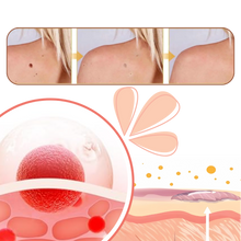 Carica l'immagine nel visualizzatore di Gallery, Rimuovi Escrescenze Cutanee Non-Invasivo - Ozerty